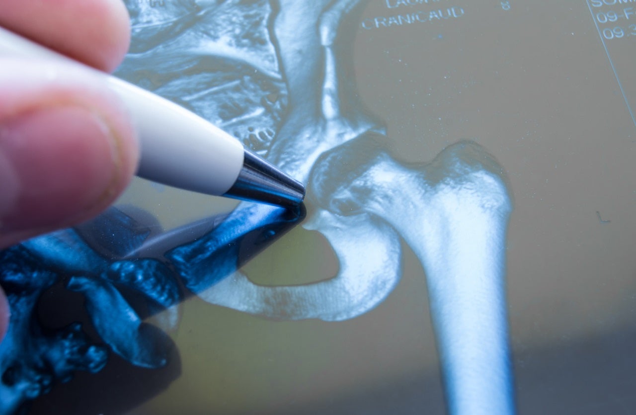Osteoporotic fractures pose serious harm to men, too: study