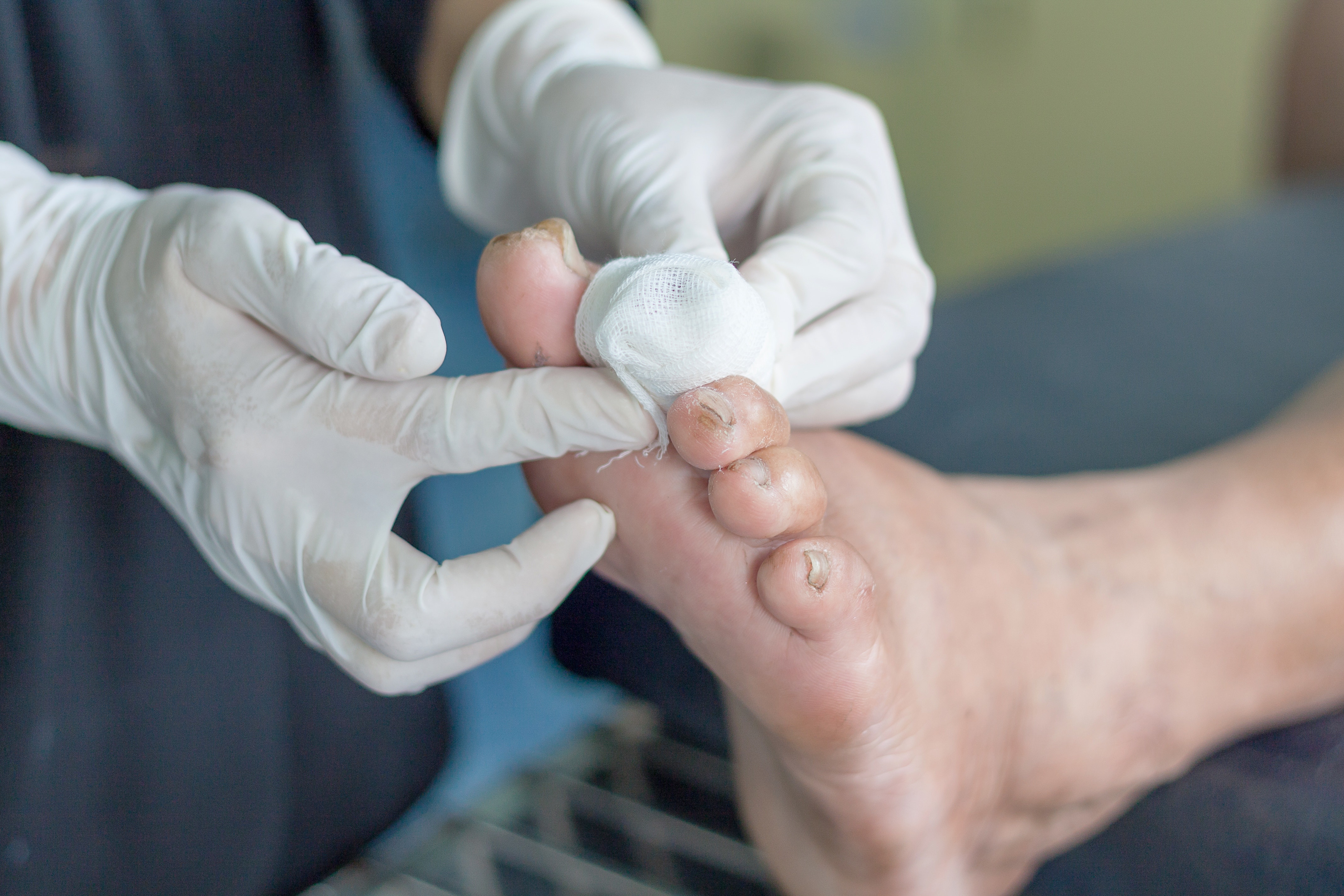 Diabetic foot ulcer treatment could kill COVID-19 virus, researchers say