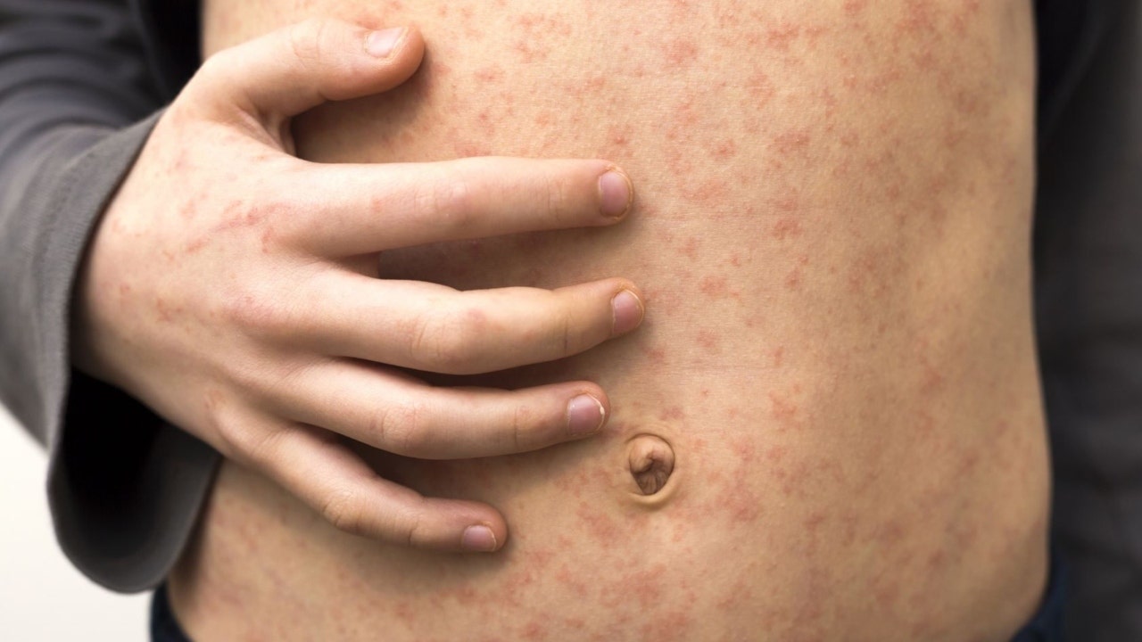 measles outbreak skin