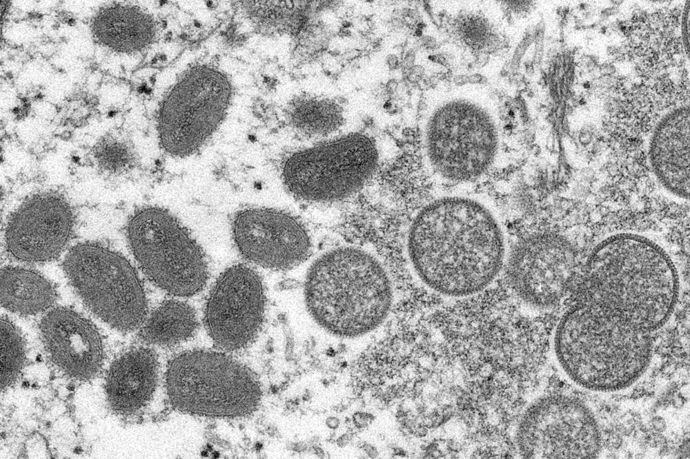 Florida health officials investigating “presumptive” monkeypox case