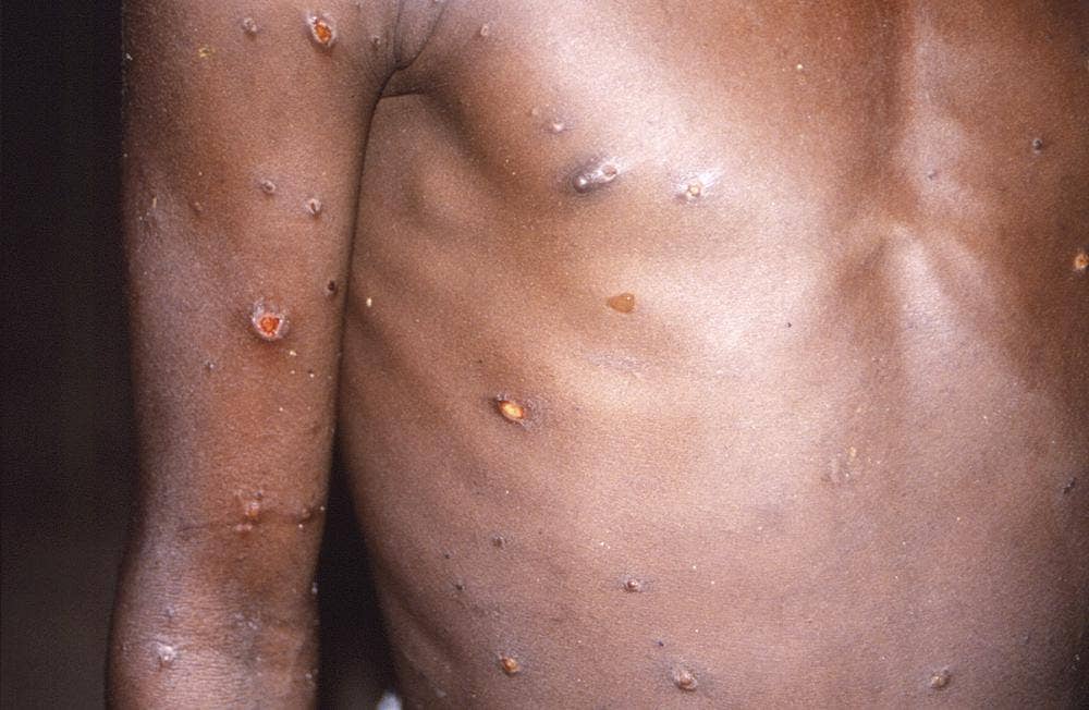 WHO: Nearly 200 cases of monkeypox virus across more than 20 countries thumbnail