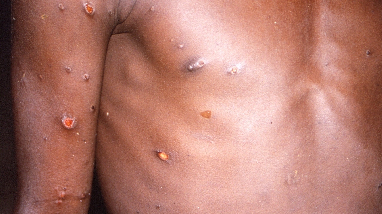 Monkeypox cases may have been spreading undetected in US Europe for years – Fox News