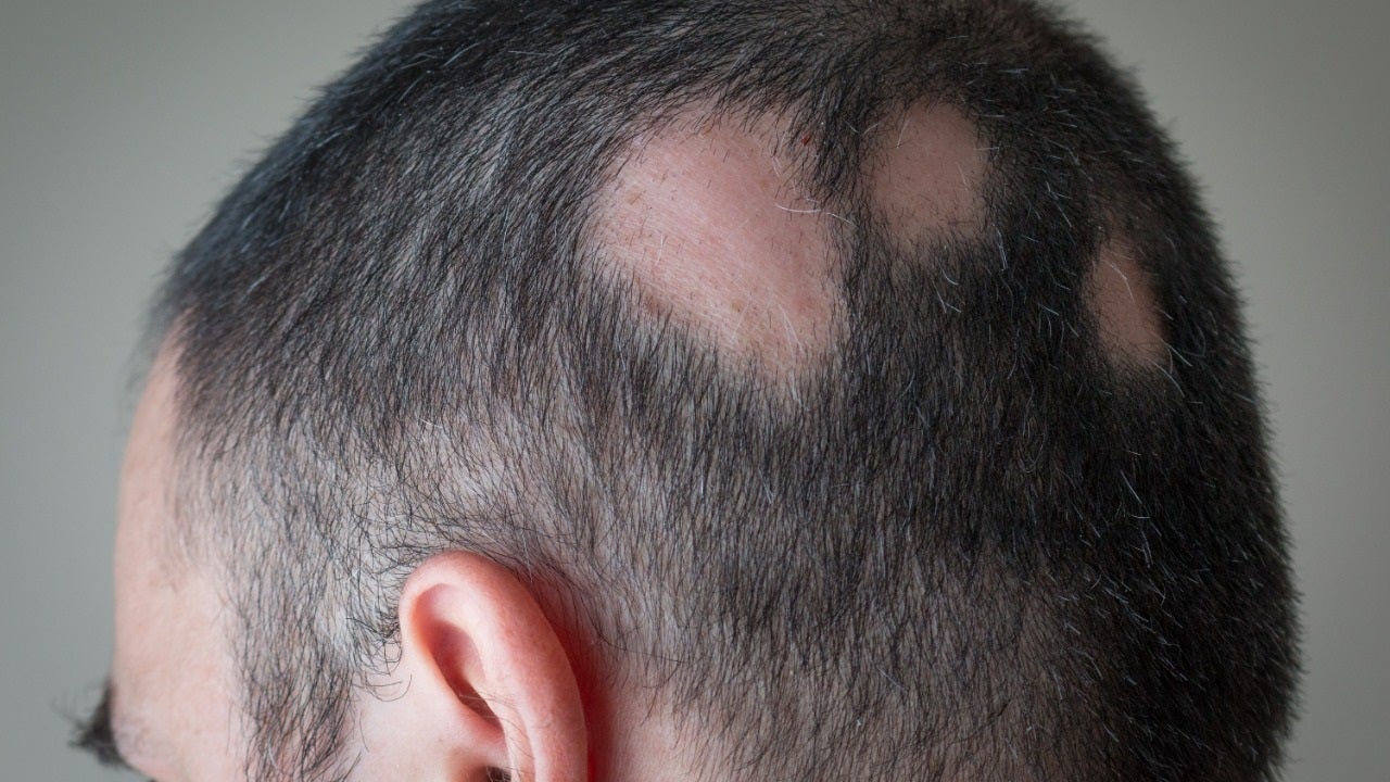 Drug to treat alopecia approved by FDA