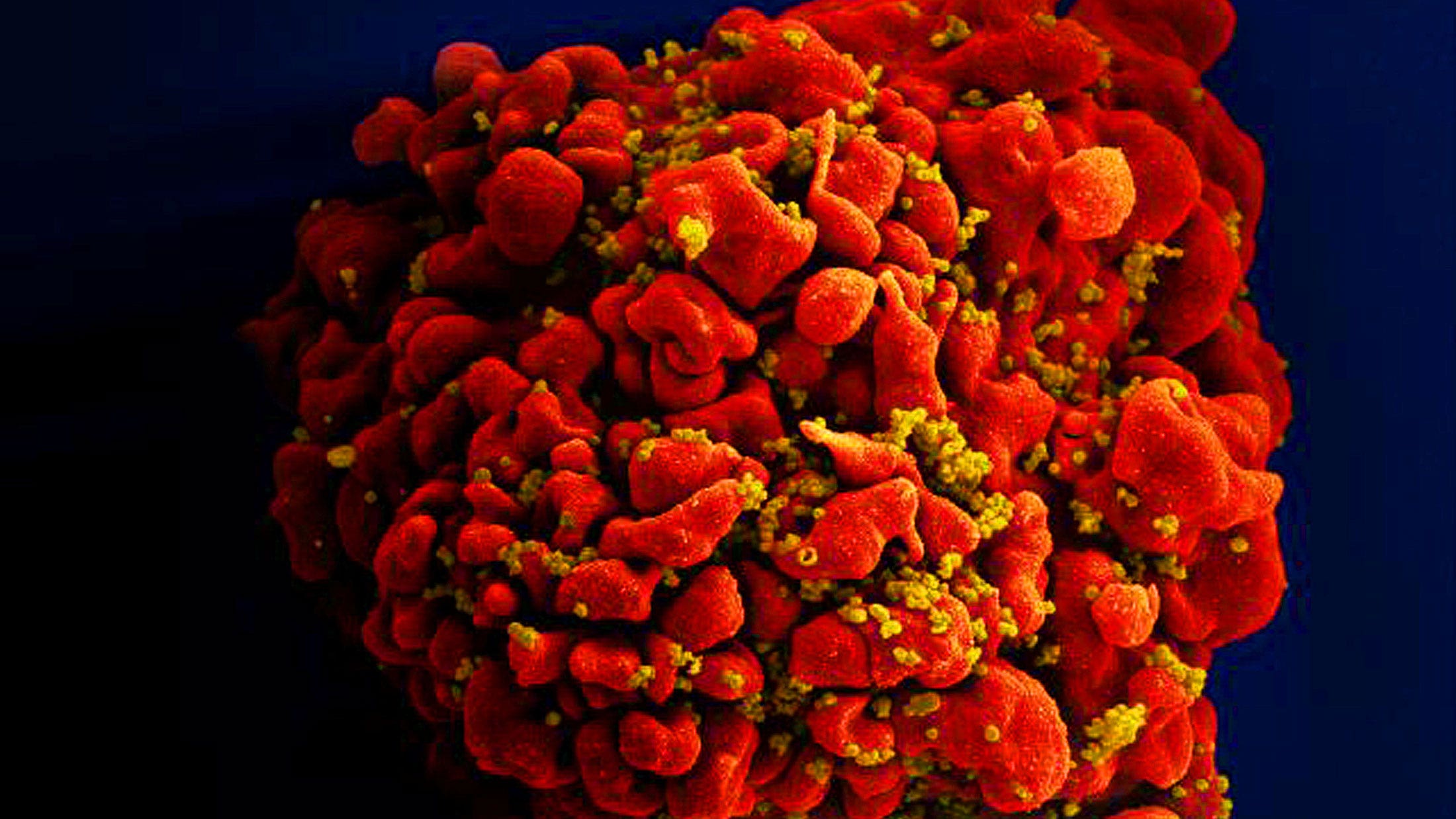 66-year-old HIV patient becomes the oldest person to be cured after stem cell transplant
