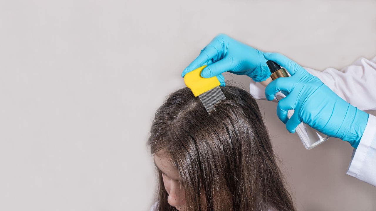 Kids with head lice don’t need to leave school: report