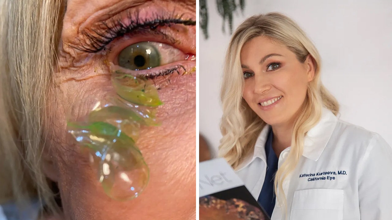 Eye spy a big problem: California doctor removes 23 contact lenses from one woman’s eye