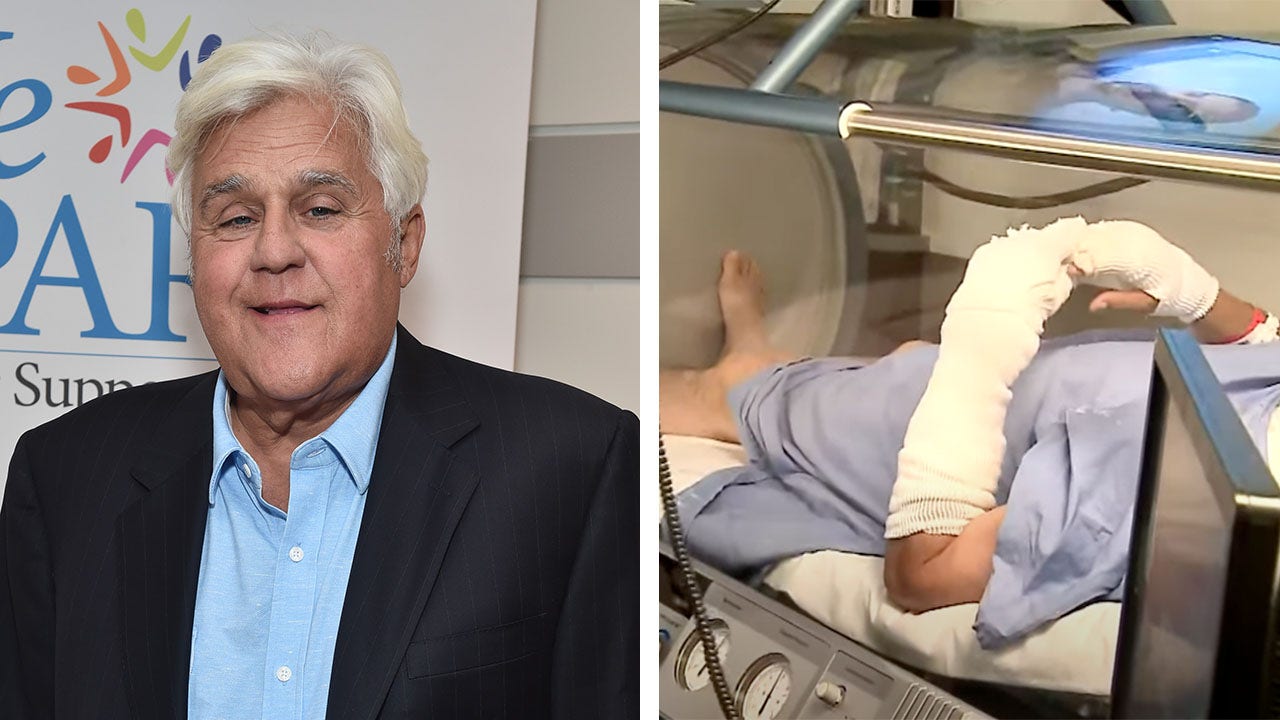 Jay Leno receives hyperbaric chamber treatment after he suffered ‘serious burns’ in gasoline fire