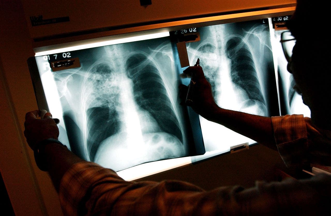 US tuberculosis cases in 2023 at highest level in decade, CDC says