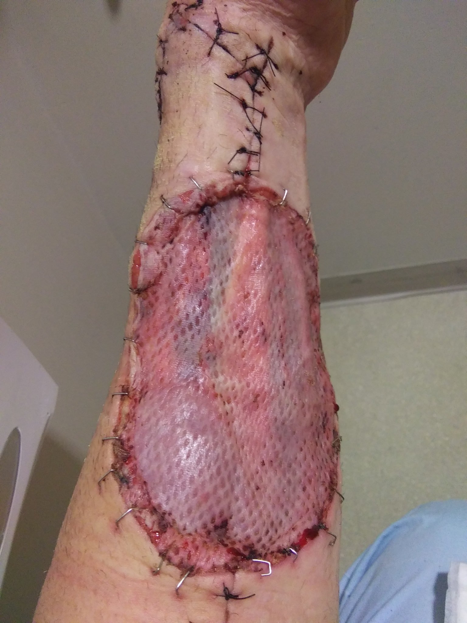 A xylazine wound on a users forearm