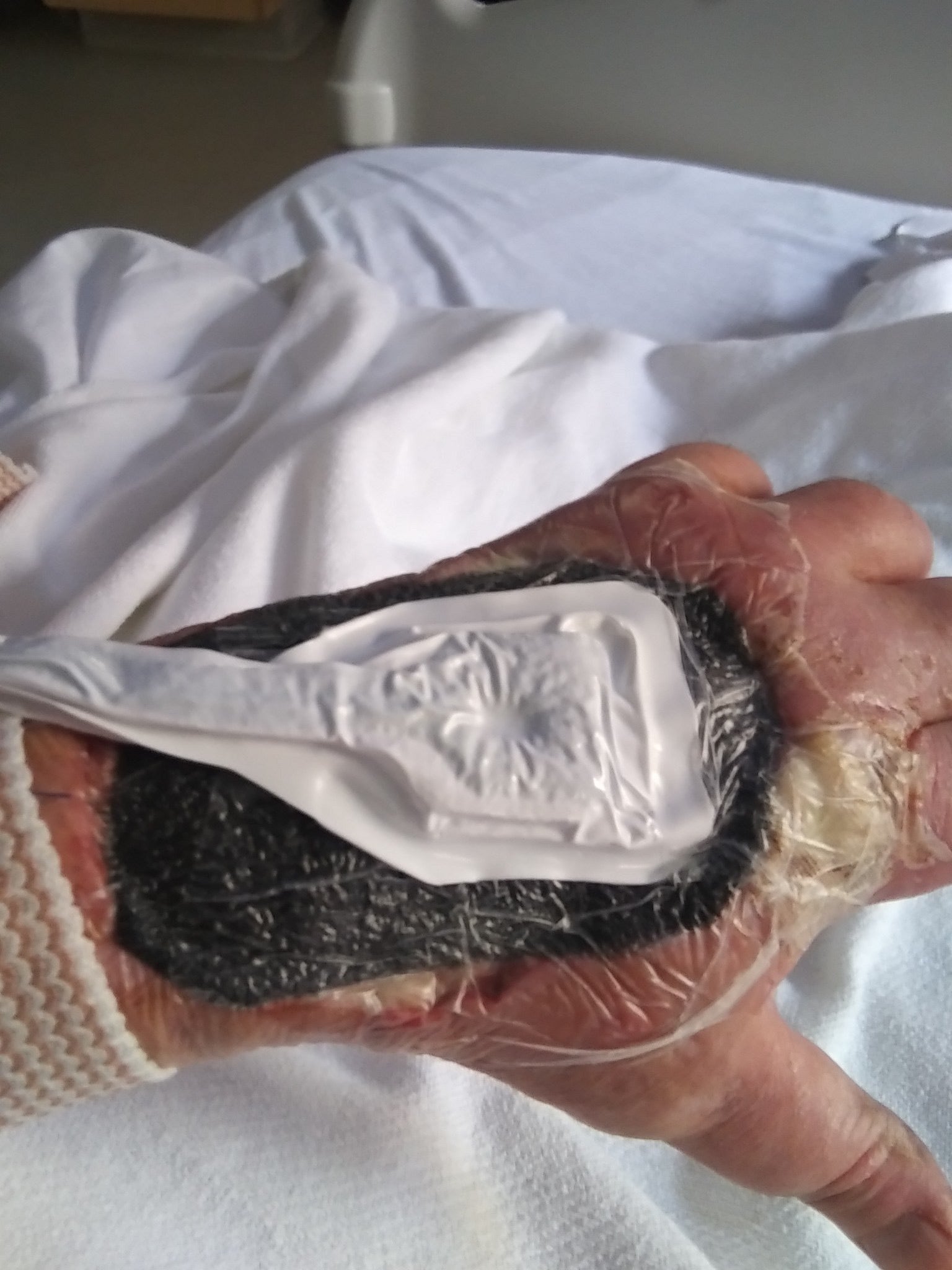 Xylazine wound on drug user's hand