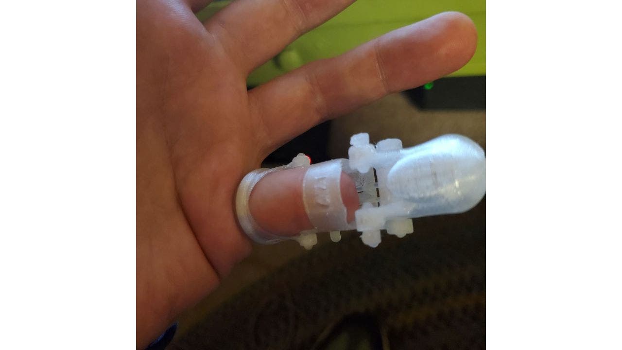 Nebraska man gets 3D-printed finger replacement 20 years after tragic mishap