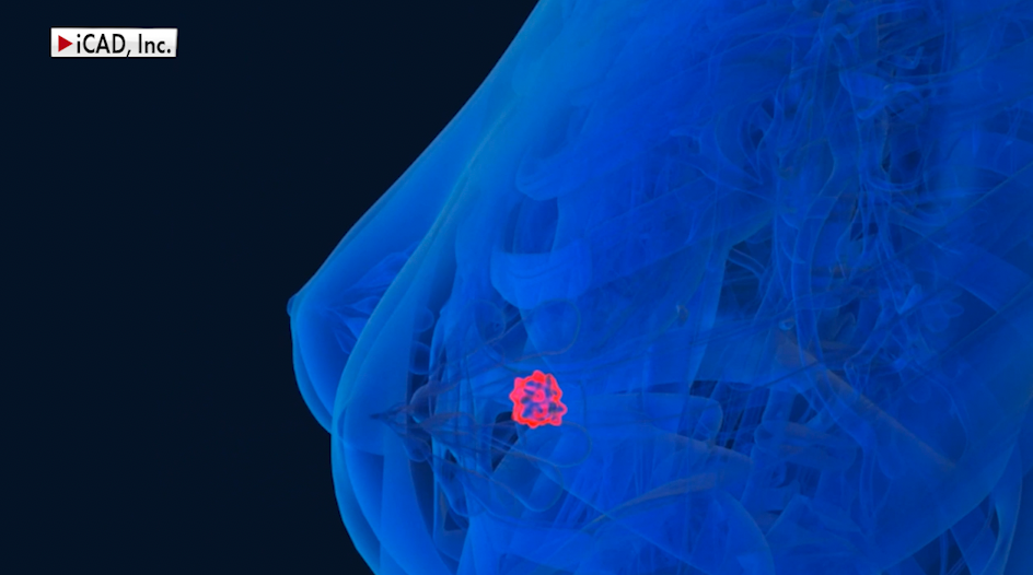 Artificial intelligence helping detect early signs of breast cancer in some US hospitals