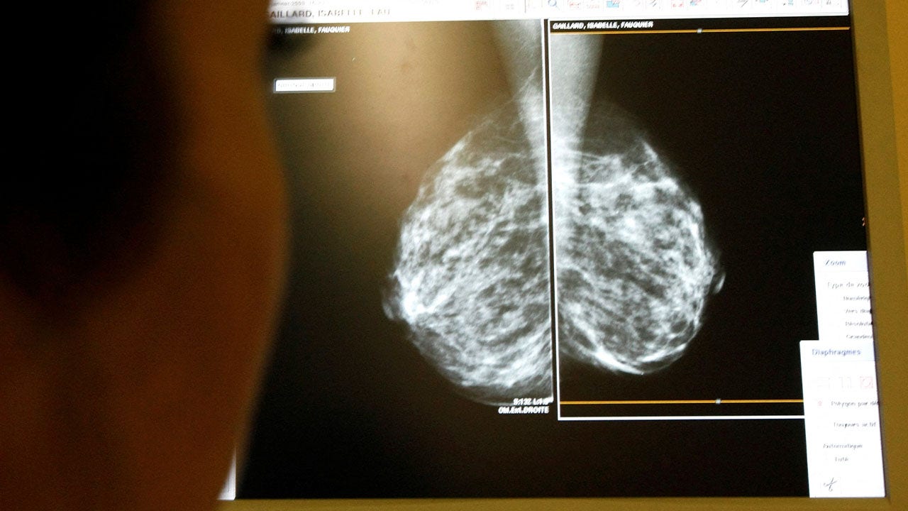 Artificial intelligence model to help scientists predict whether breast cancer will spread