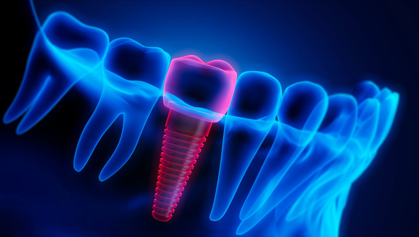 AI in dentistry: Researchers obtain that synthetic intelligence can produce much better dental crowns