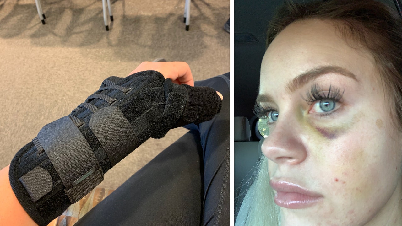 Deputy McCarthy's injuries to her hand and face