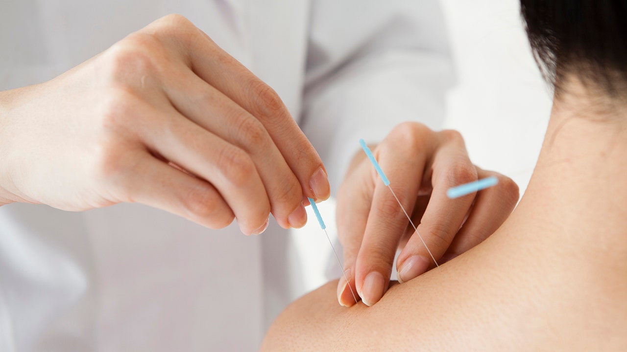 woman receives acupuncture