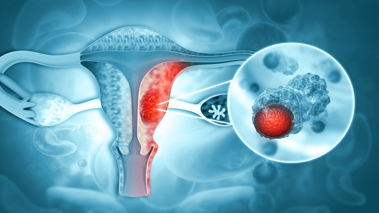 Uterine cancer