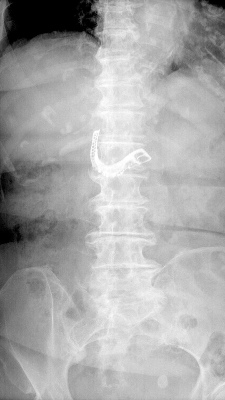 Dentures swallowed