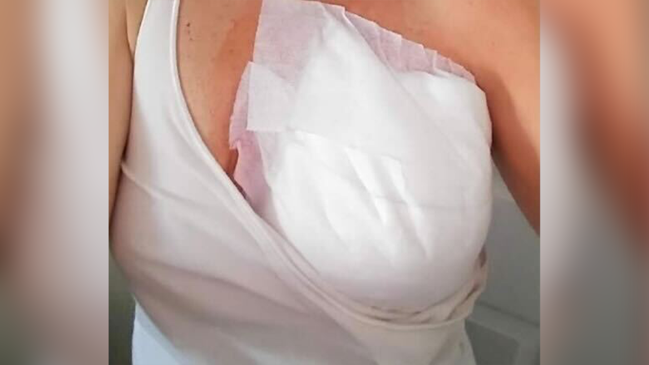 Tami Burdick breast post-operation