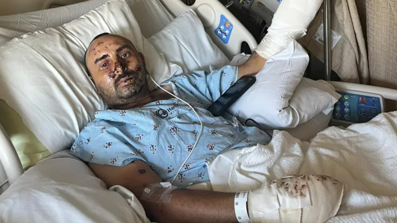 California gardener loses hand, eyesight after picking up undetonated firework believed to be trash