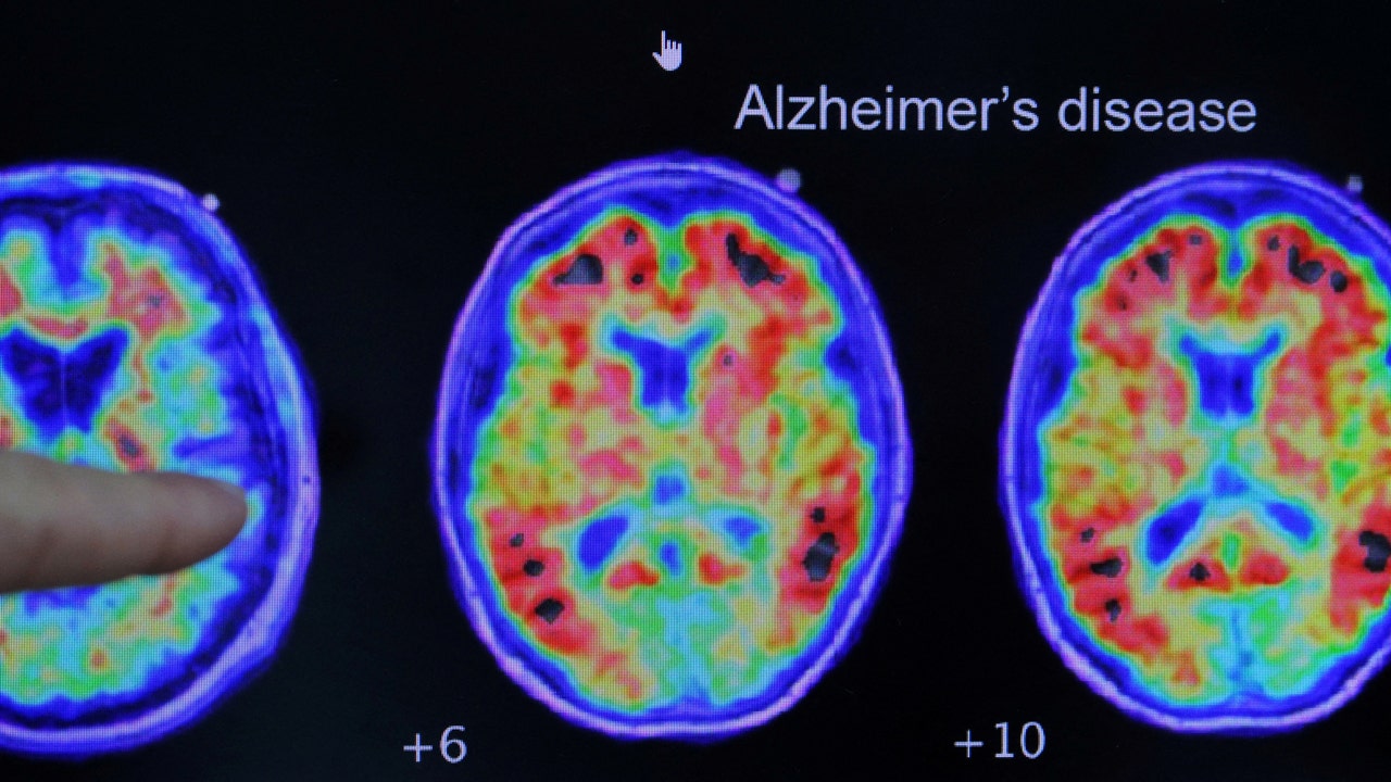 Japanese Health Ministry Panel Recommends Approval Of Alzheimer's ...