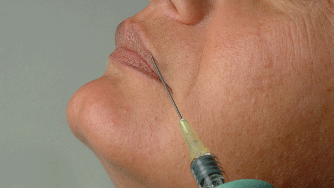 A close up of a lip injection