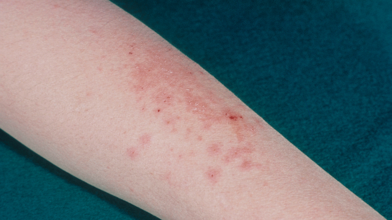 Eczema on arm