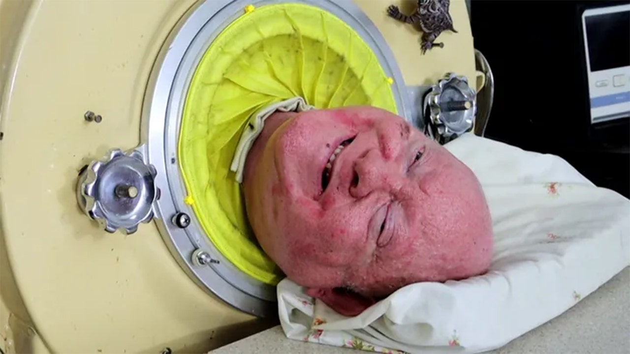 Read more about the article Man who spent 70 years living in iron lung, dead at 78