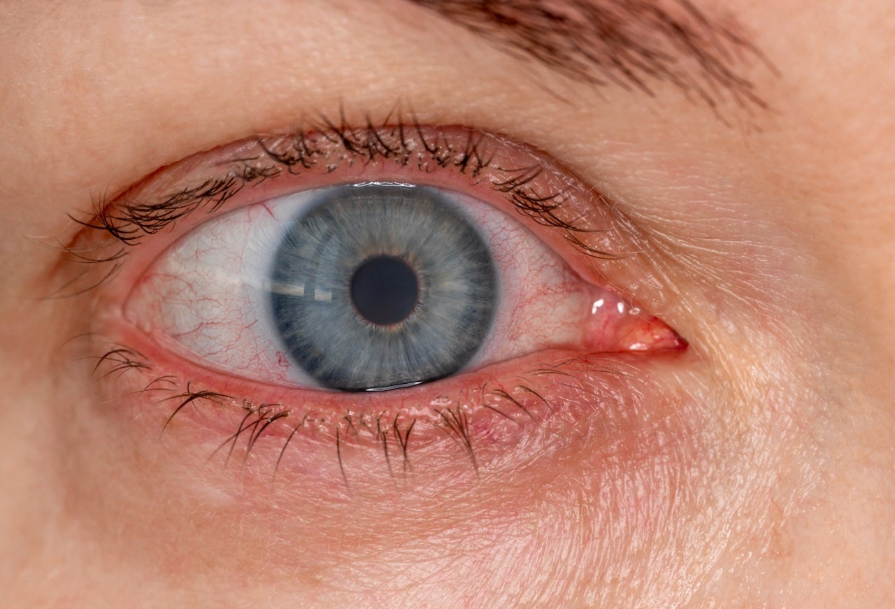 Bloodshot eyes are very common and rarely indicate something serious, a doctor noted. (iStock)