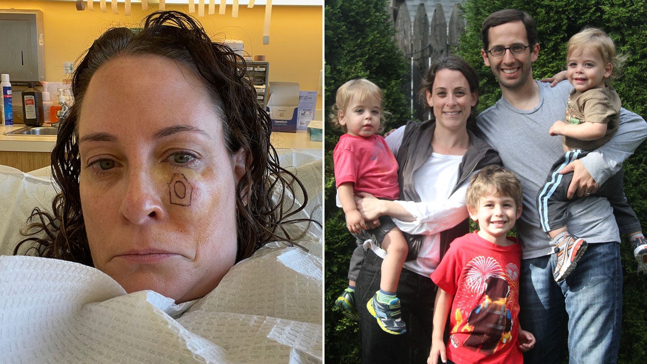 Read more about the article Melanoma patients reveal stories for Skin Cancer Awareness Month: ‘I thought I was careful’