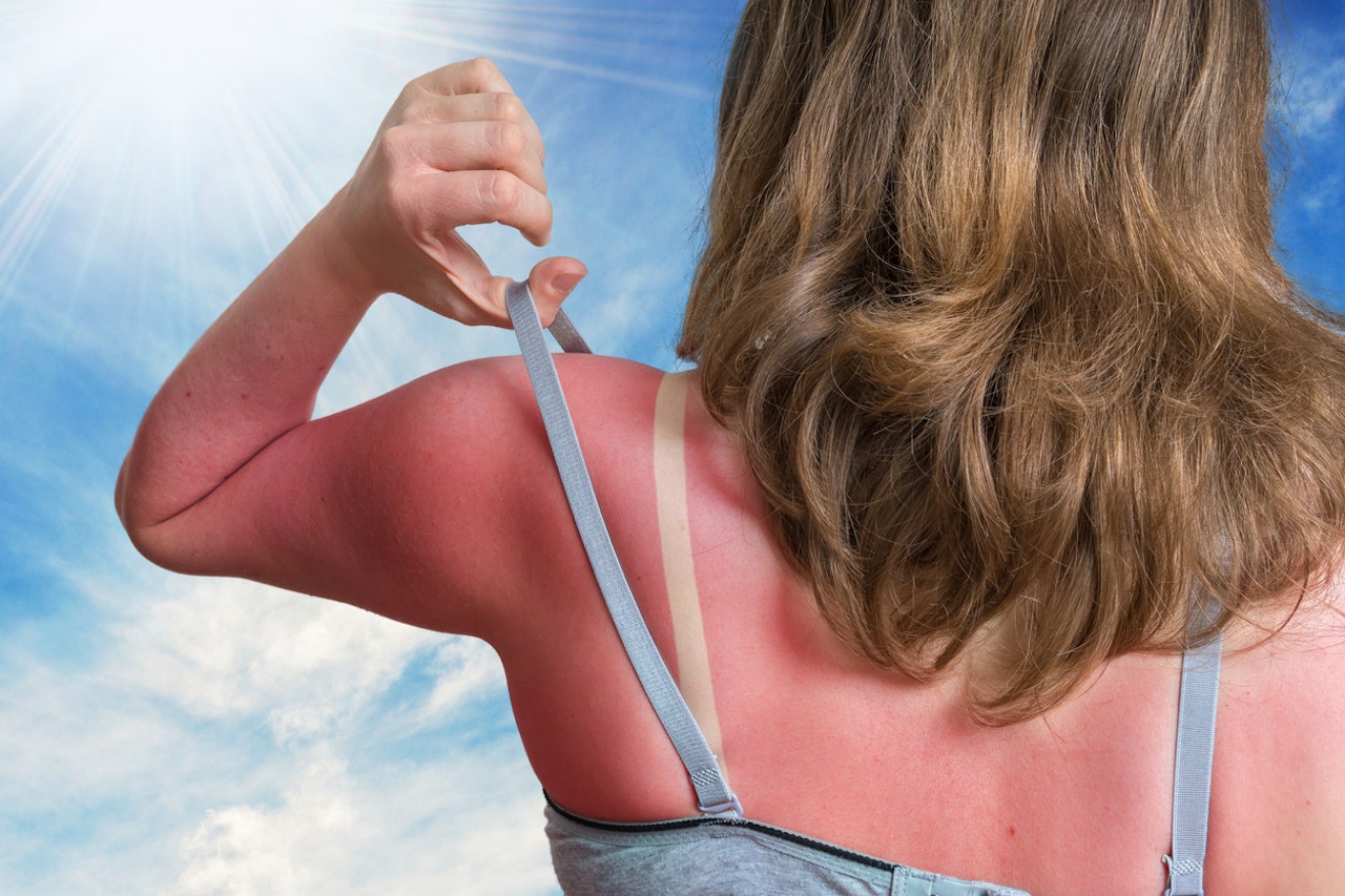Sunburn SOS: 7 tips to soothe your sun-damaged skin, according to a wellness expert