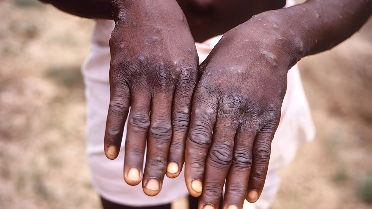 What to know about Mpox as it’s declared a public health emergency in Africa