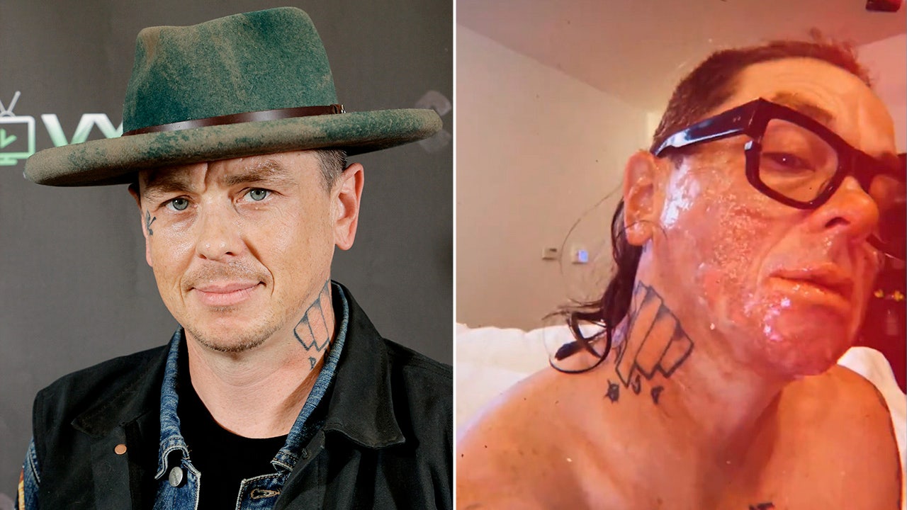 Slipknot's Sid Wilson describes gruesome injuries after campfire explosion: “My face practically melted”