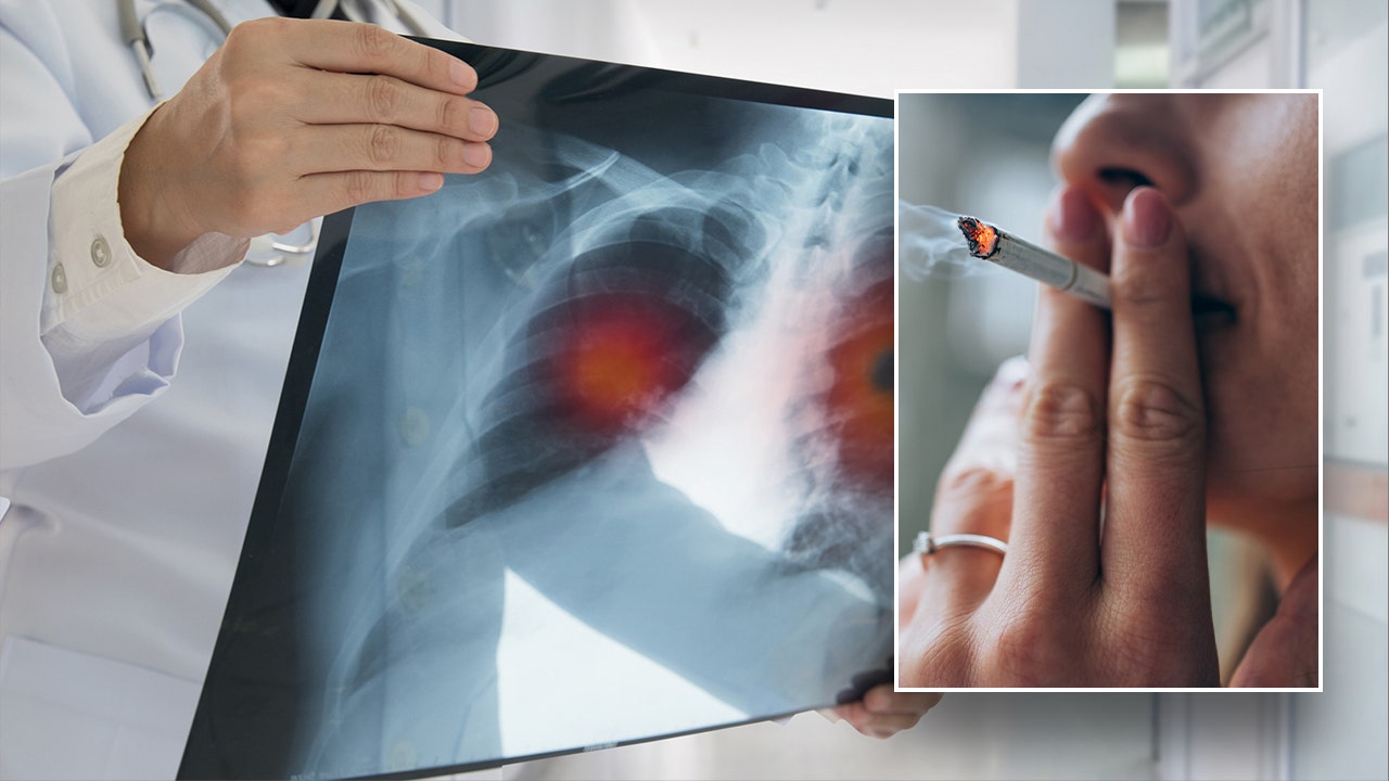 Learn more about lung cancer, the disease that impacts thousands of ...