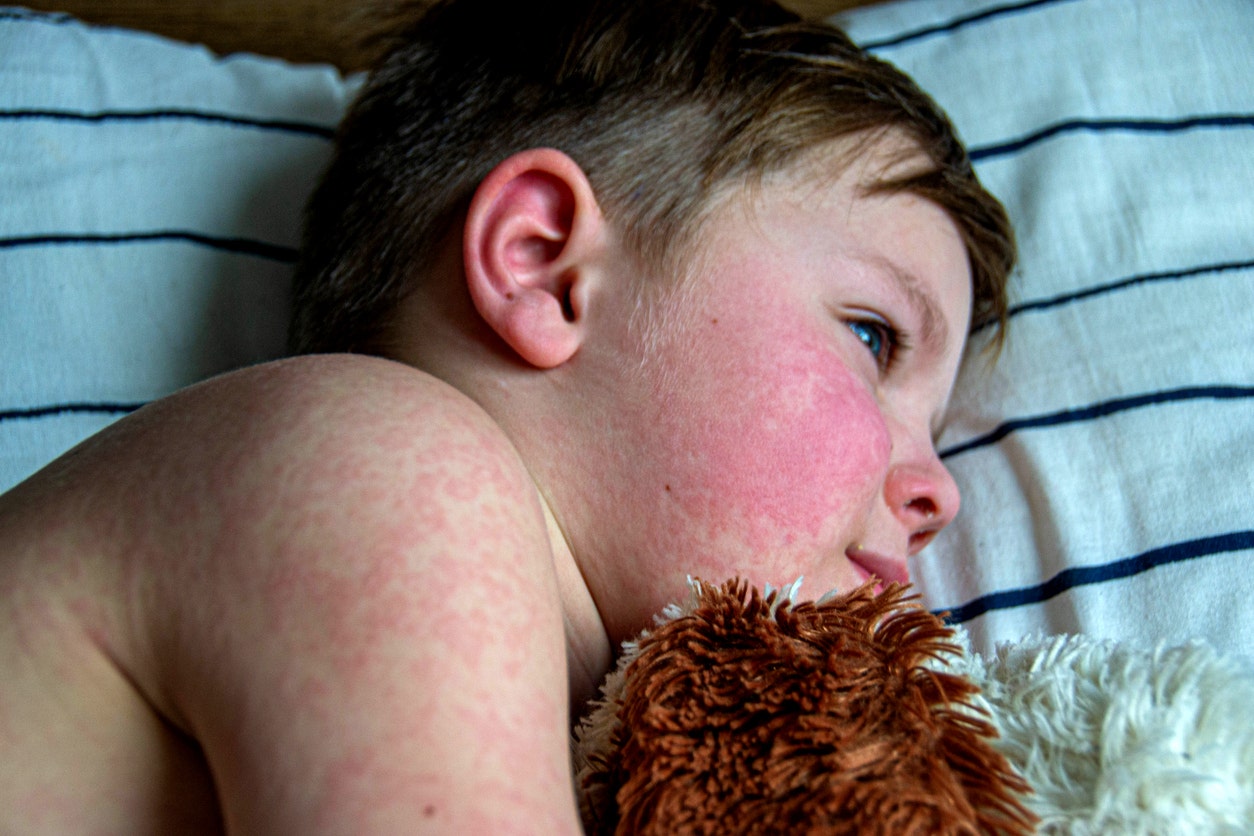 Parvovirus or ‘slapped cheek disease’ is on the rise, says CDC, what to know