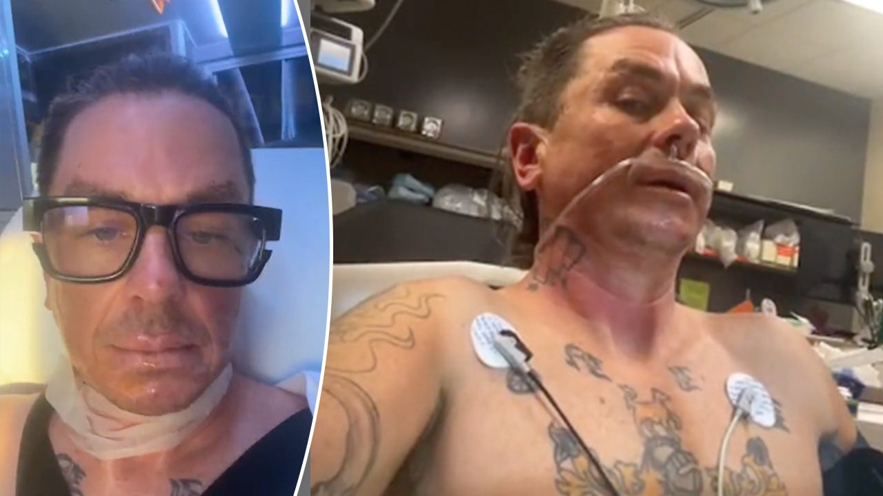 Slipknot’s Sid Wilson suffers severe burns after farm explosion