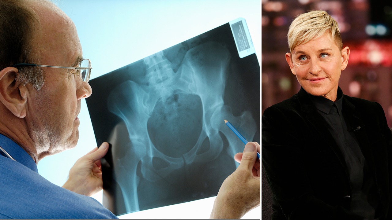 Ellen DeGeneres has osteoporosis: Here’s what to know about the painful bone condition