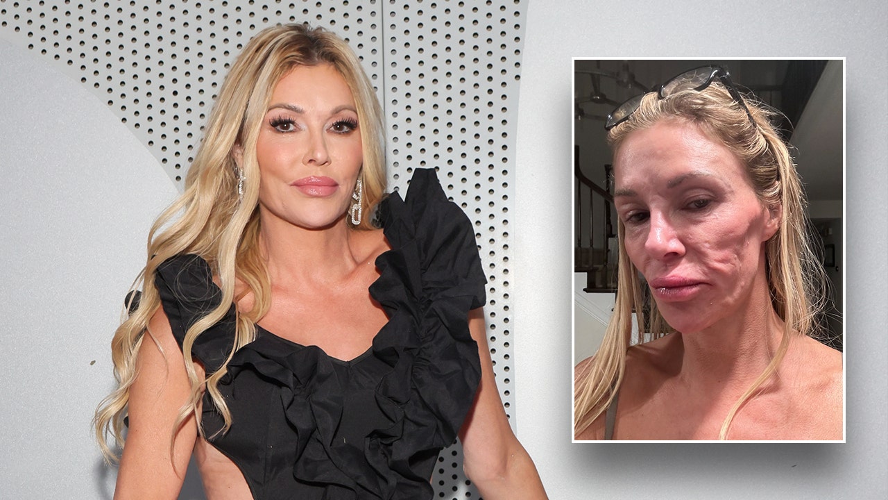 Brandi Glanville spending 'all of my money' looking for answers to mystery illness that left her disfigured