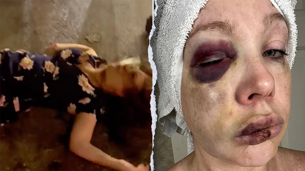 Cincinnati beatdown victim reveals ‘very bad brain trauma’ in first remarks since viral assault