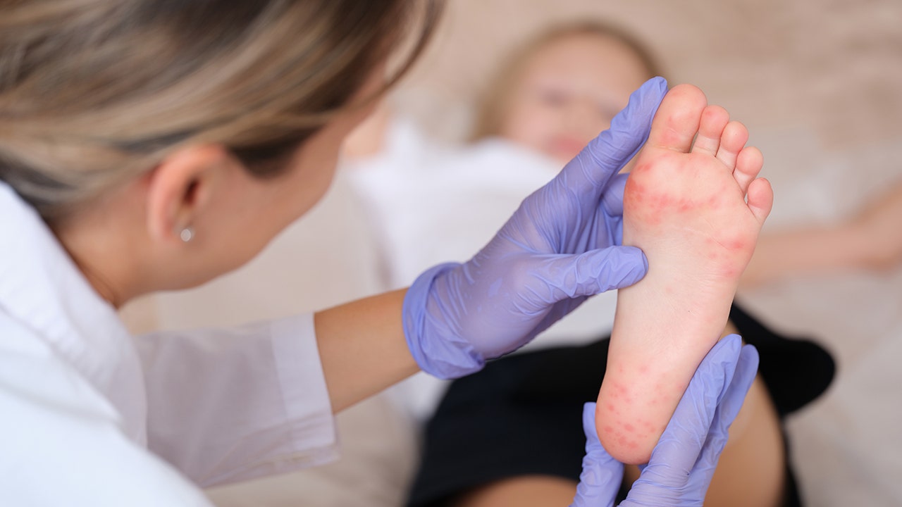 Highly contagious disease surges in some US states amid report of possible fatal case