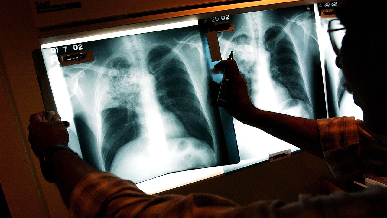 Three active tuberculosis cases reported in Maine as deadly disease continues to tick up across country