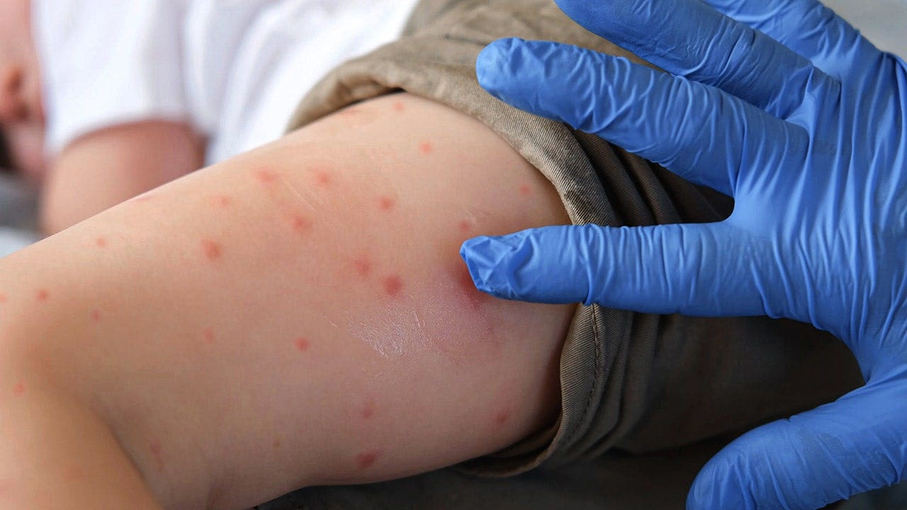 Pennsylvania measles deaths reported in unvaccinated Lancaster residents